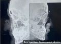 Владимирские врачи спасли женщине лицо после трагедии на мосту
